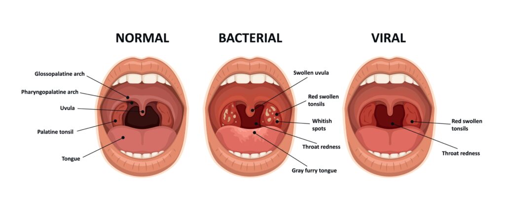 Can Tonsillitis Cause Red Spots On Tongue