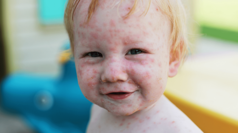 When is Chickenpox Contagious?