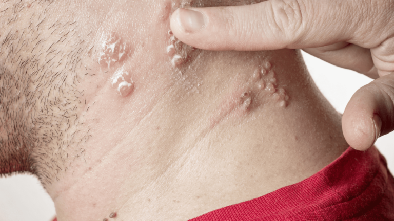 What Are the Symptoms of Shingles?