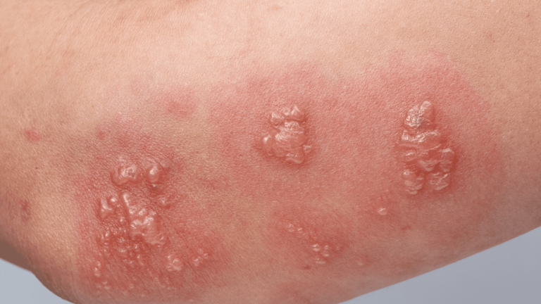 What Are the Symptoms of Shingles?