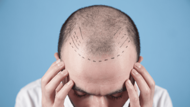 man anxious about receding hairline