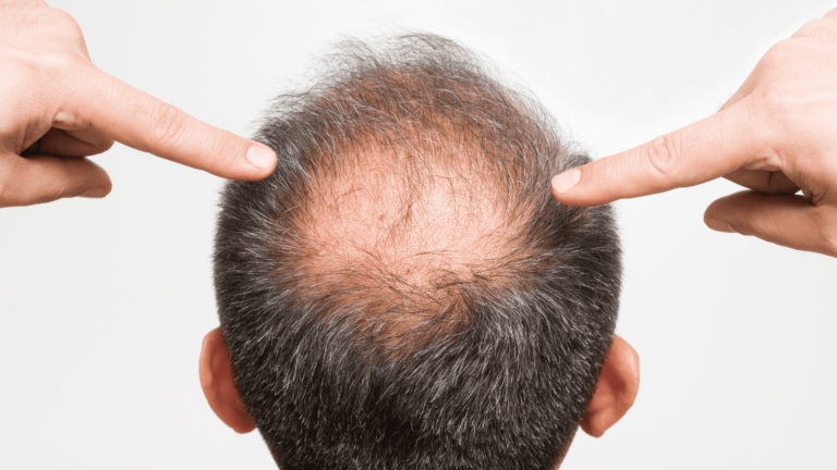mens baldness at the back of the head